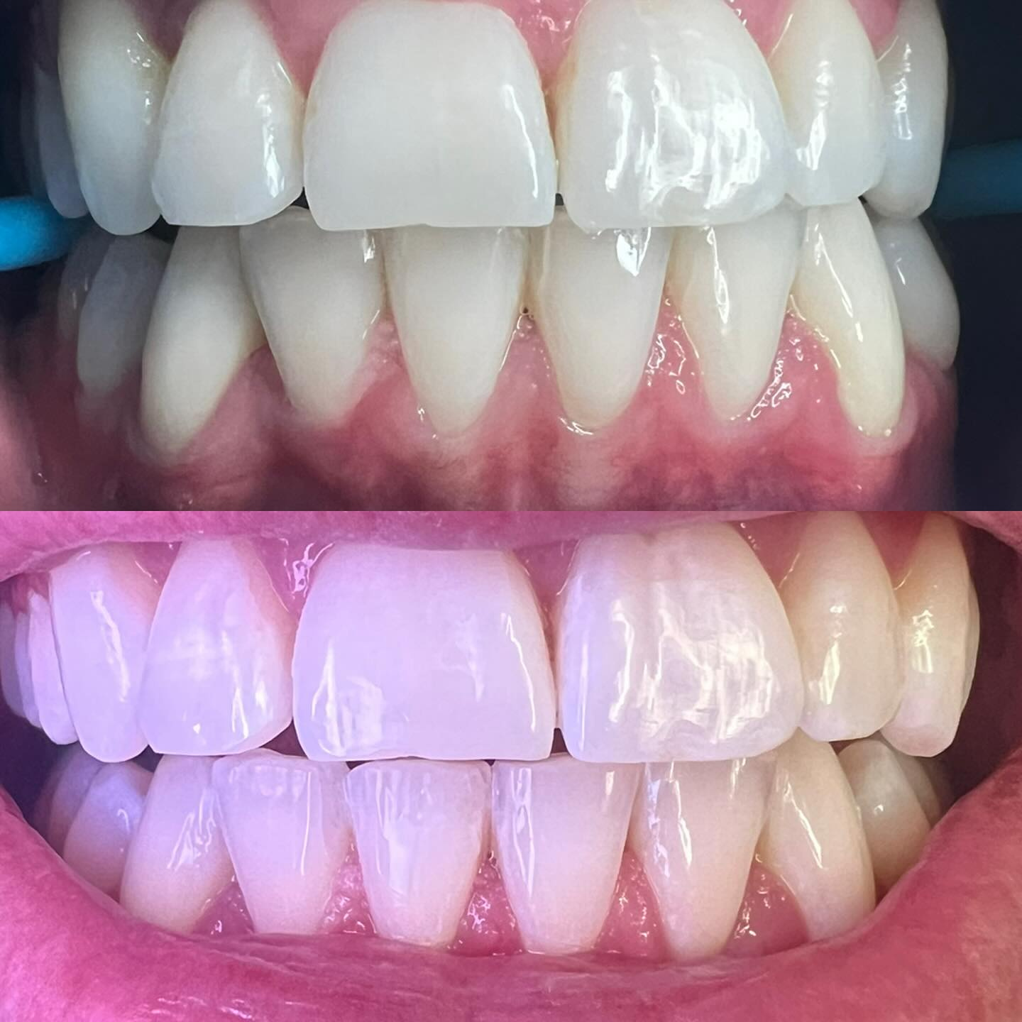 Smile Teeth Whitening Dublin | The Glow Bar