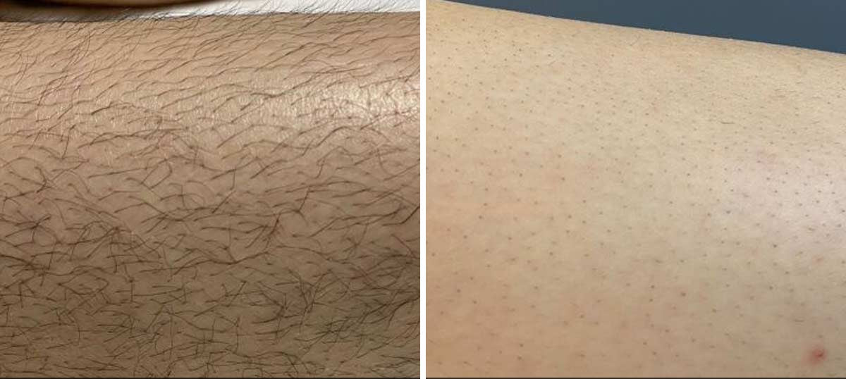 Laser hair removal results